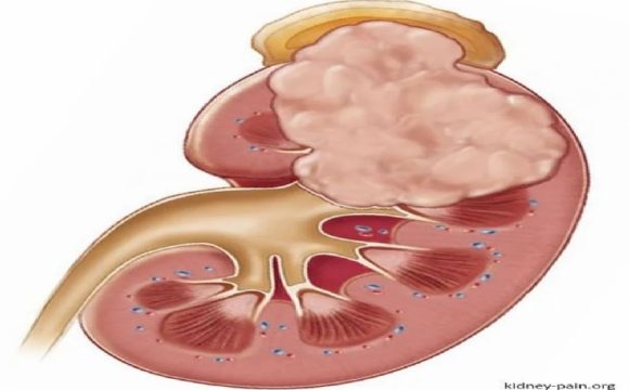 Kidney Cancer: Causes, Symptoms, Stages, Surgery and Treatment