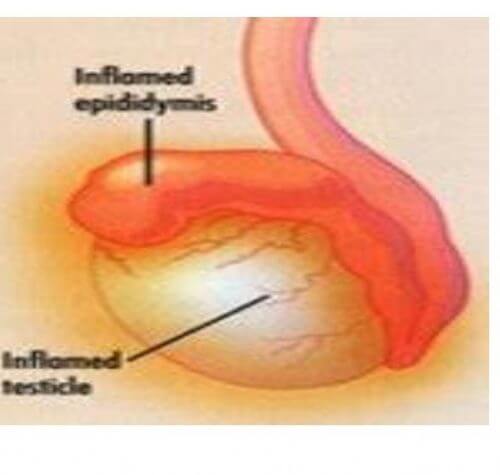 Epididimoorşit: Nedir Tanı ve Tedavisi