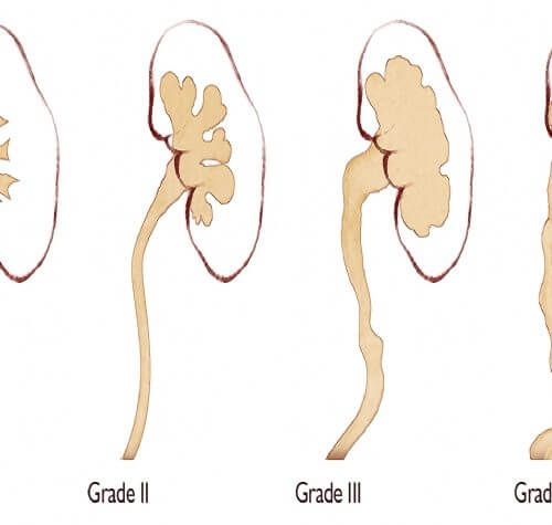 Hidronefroz (Unilateral ve Bilateral): Nedir Nedenleri Tanı ve Tedavisi