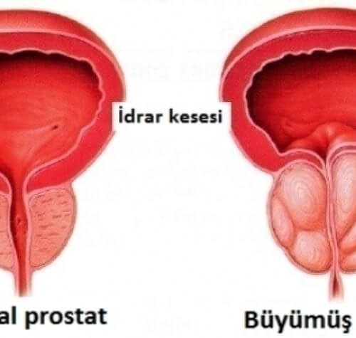 İyi Huylu Prostat Büyümesi – BPH