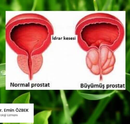 İyi Huylu Prostat Büyümesi (BPH): Bitkisel Tedavi (Fitoterapi)