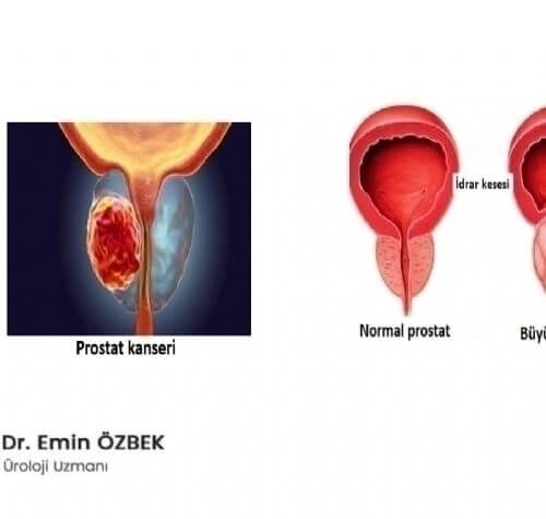 İyi Huylu Prostat Büyümesi ile Prostat Kanseri Nasıl Ayırt Edilir?