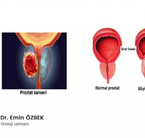 İyi Huylu Prostat Büyümesi Kansere Dönüşür mü (Kanserleşir mi)?