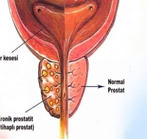 Kronik Prostatit Nedir Belirtileri Tanı ve Tedavisi