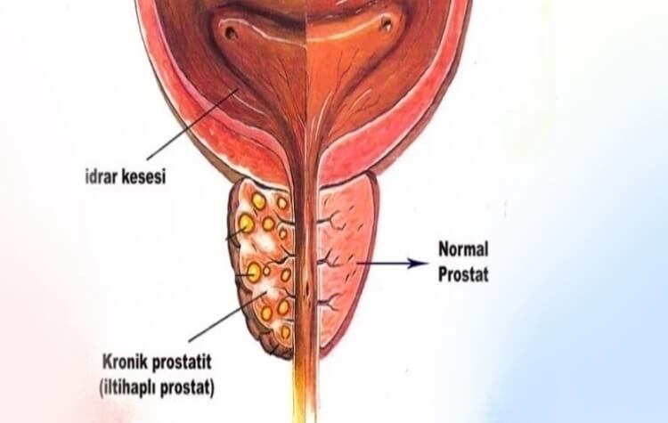 Prostatit yüksek tansiyon