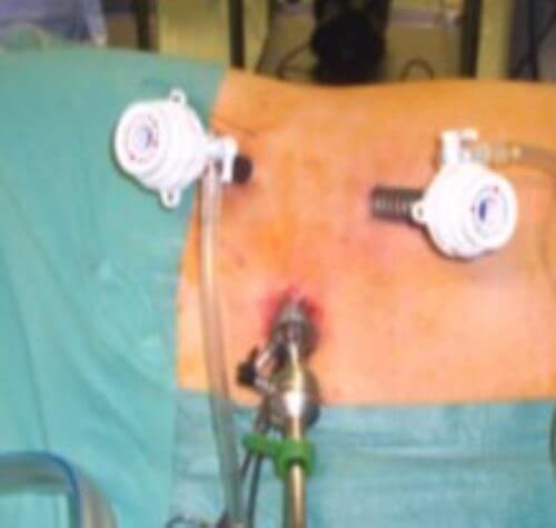 Laparoskopik Radikal Nefrektomi (Kapalı Yöntemle Böbrek Kanseri Ameliyatı / Böbreğin Alınması)