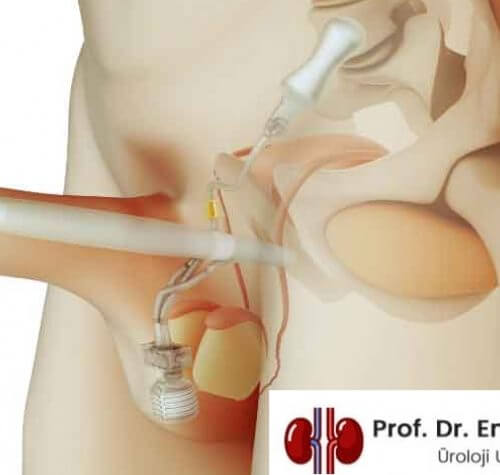 Mesane Kanseri Yapay Mesane ve Prostat Kanseri Ameliyatı Sonrası Penis Protezi