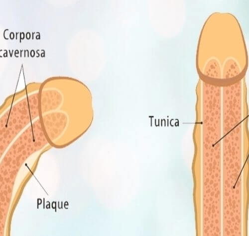 Peyronie Hastalığı İle İlgili Sık Sorulan Sorular ve Cevapları