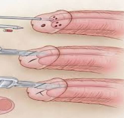 Priapizm Nedir Nedenleri Çeşitleri Tanı ve Tedavisi