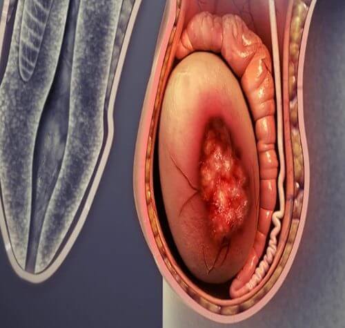 Testis Kanseri: Belirtileri Tanı ve Tedavisi