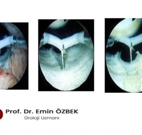 Transüretral Prostat İnsizyonu (TUİP) Nedir ve Kimlere Yapılır?