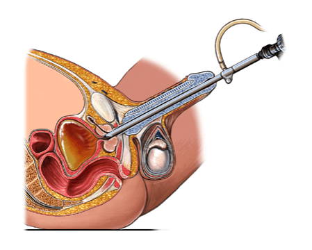 Transüretral prostat rezeksiyonu