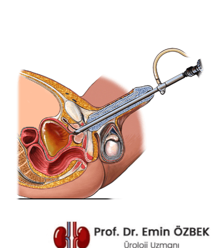 Transüretral prostat rezeksiyonu