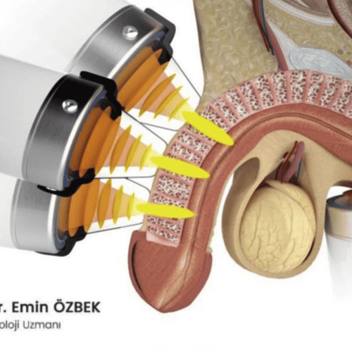 Ereksiyon tedavisinde ESWT nasıl çalışır
