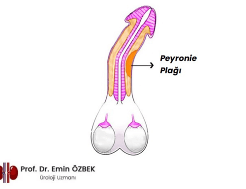 Peyronie plağı