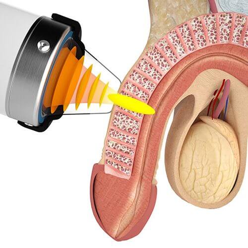 Ereksiyon Sorunu Tedavisinde ESWT En İyi Nasıl Etki Gösterir