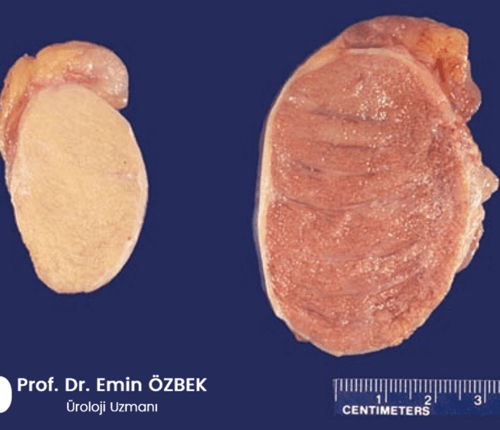 Testis Atrofisi