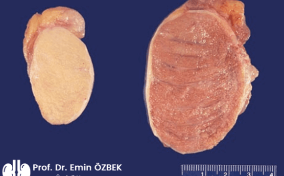 Testis Atrofisi