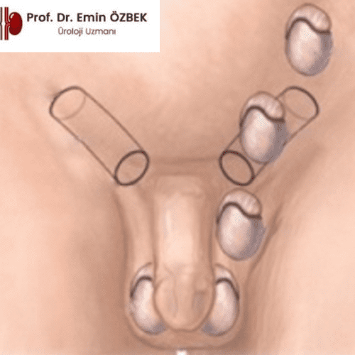 İnmemiş Testis