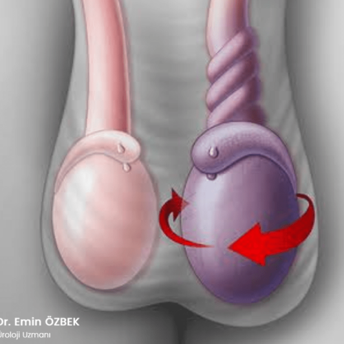 Testis-Torsiyonu-Nedenleri-Tani-ve-Tedavisi