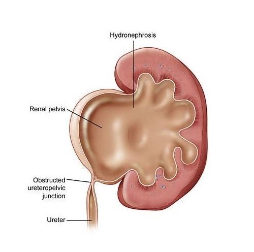 Ureteropelvic Junction Obstruction What is It, Symptoms, Diagnosis and Treatment