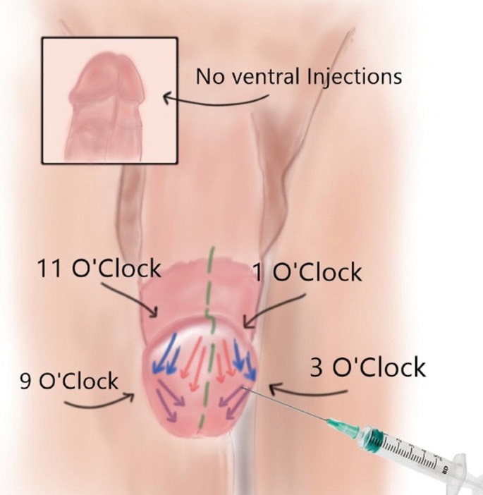 Otolog Yağ Enjeksiyonları ile Penis Büyütme