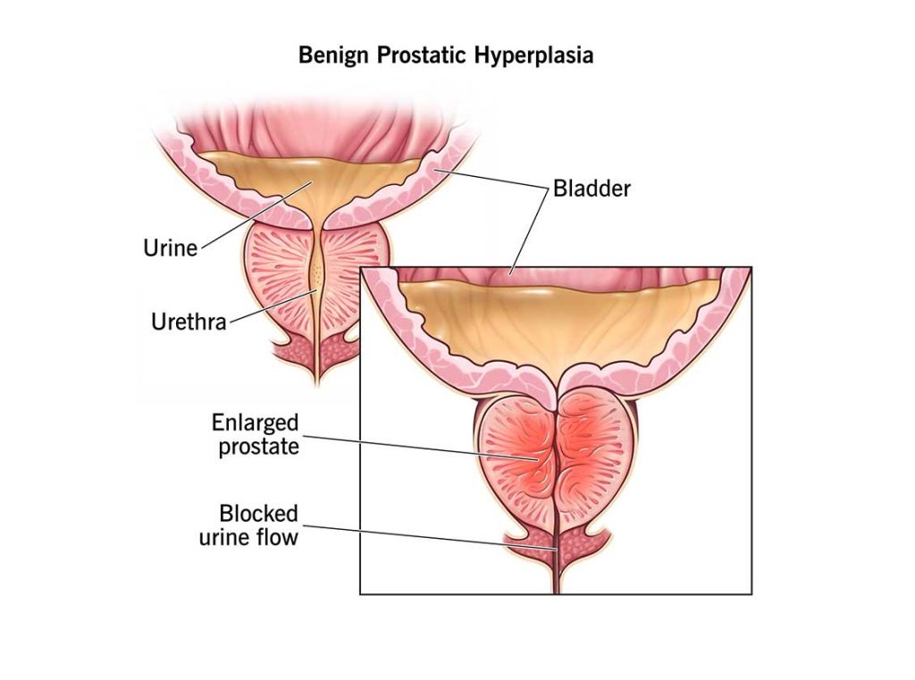 İyi huylu Prostat Hiperplazisi (BPH) Tedavisinde Kullanılan İlaçlar