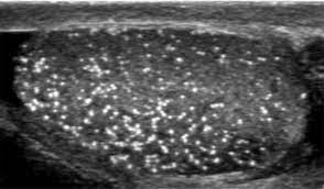 Testicular microlithiasis 