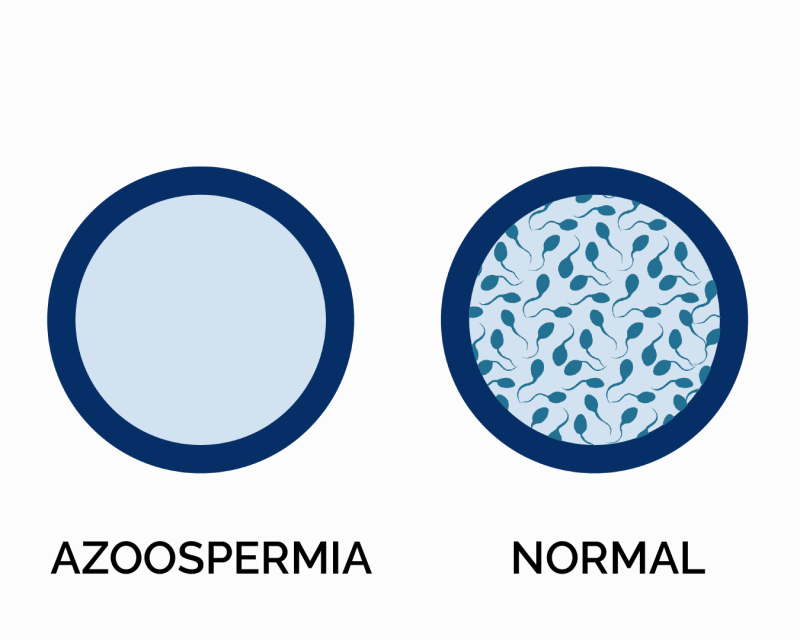 Azoospermi: Nedir, Tanı ve Tedavisi