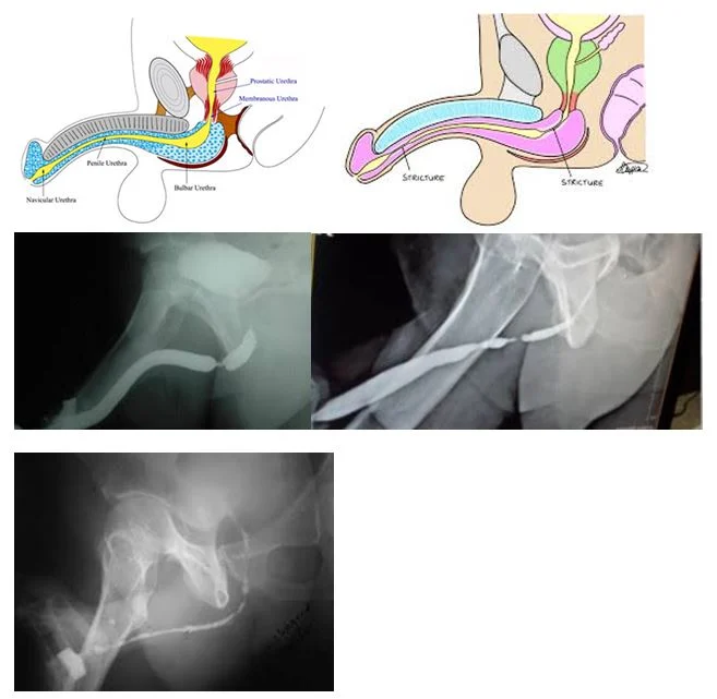 Üretra Darlığı, İnternal Üretrotomi ve Üretroplasti Sık Sorulan Sorular