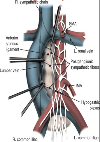 Testis Kanseri ve Retroperitoneal Lenf Bezi Diseksiyonu (RPLND)