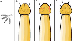 Erken Boşalma ve Penis Başına Dolgu ile Tedavisi