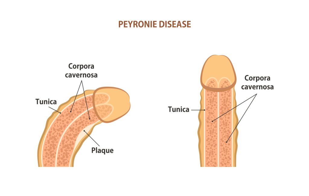 Diseases & Conditions Associated with Peyronie’s Disease