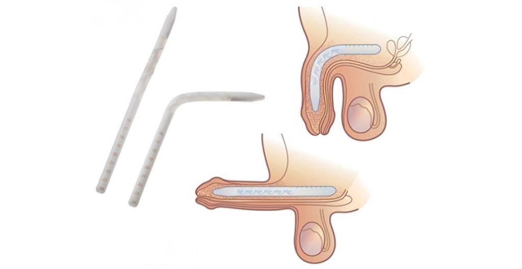 Yasli-Kisilerde-Penis-Protezi-Ameliyati