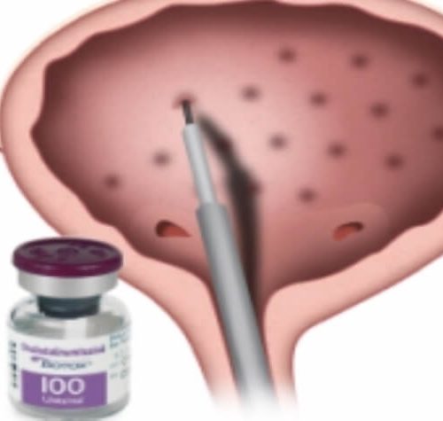 Botox Pour le Traitement De La Vessie Hyperactive