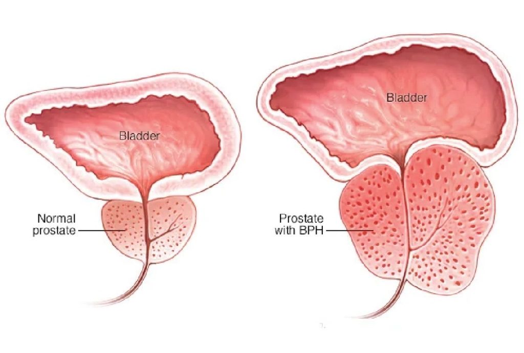 Benign-Prostat-Hiperplazisi-Nasil-Gelisir